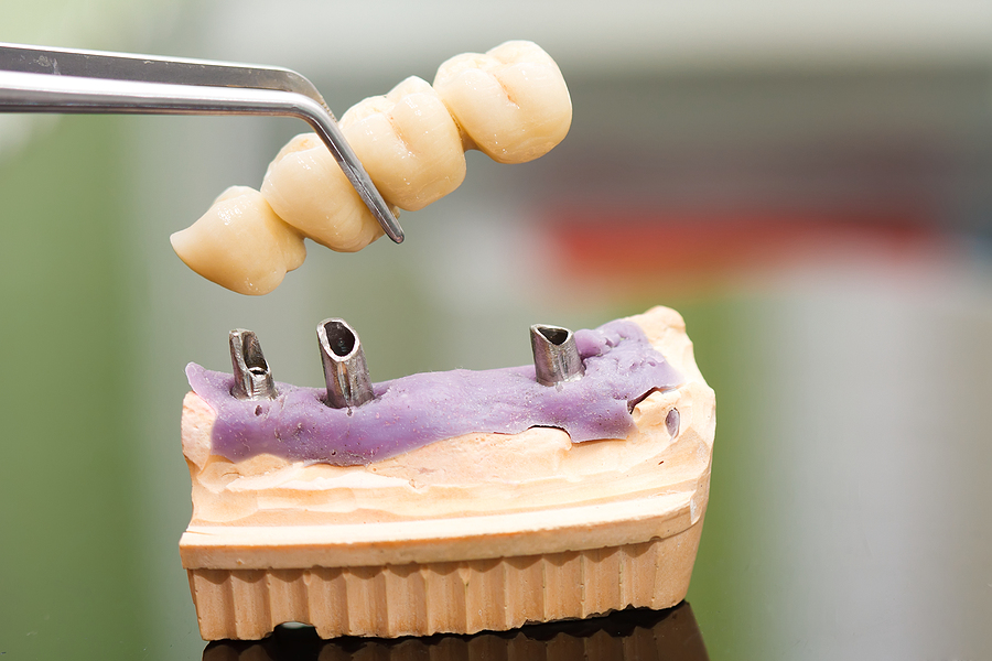 Restore Your Smile with Partial Dentures in Port Charlotte, FL
